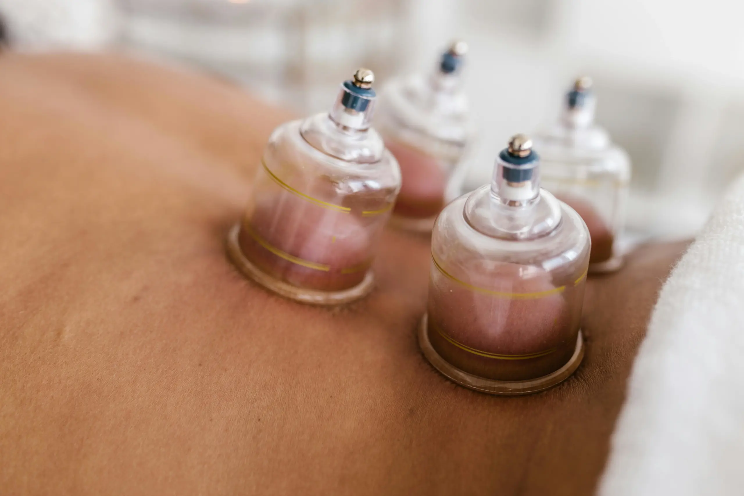 Cupping - Kempton